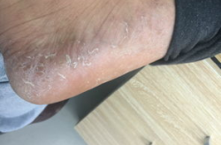 脚痒脱皮起水泡烂脚丫用哪些药好,这些药物帮你轻松解决
