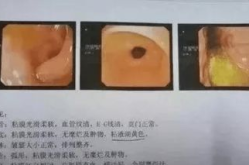 胆汁反流性胃炎严重吗,不容忽视的胃部“叛逆”