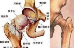 股骨头坏死的原因,成因解析与预防措施